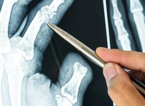 Bone-02: клей для костей, ускоряющий заживление переломов всего за 3 минуты