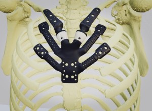 В России разработан гибкий имплантат грудины на 3D-принтере