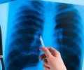 Флюорография выявляет до 60% случаев туберкулёза на ранней стадии в ПМР