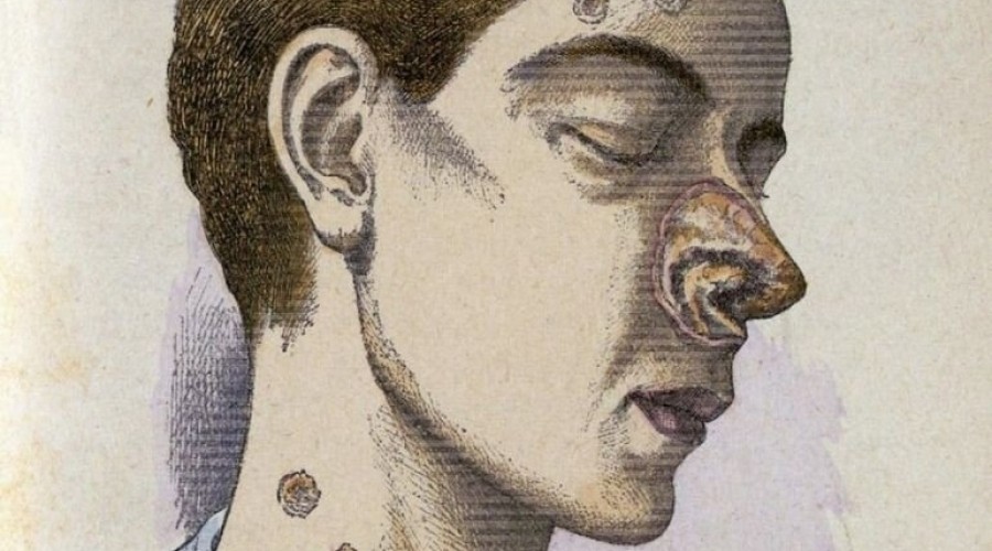 Тёмная сторона Ренессанса: сифилис и «эпоха зомби» в Европе