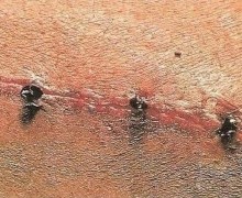 Как в Африке используют муравьёв для зашивания ран