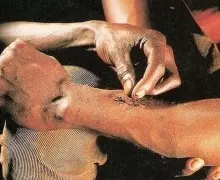 Как в Африке используют муравьёв для зашивания ран